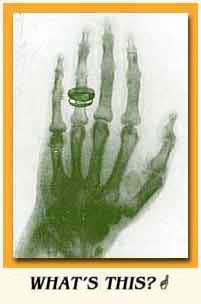 One of Roentgen's first X-ray photographis -- a colleagues hand (note the wedding ring).